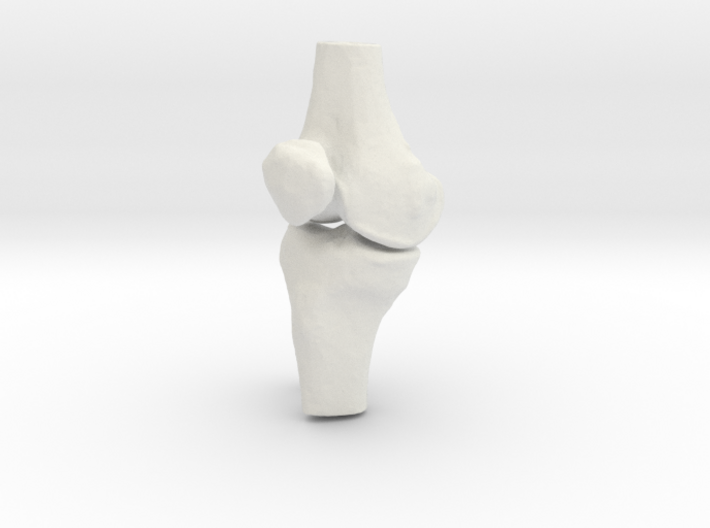 Knee - Proximal Tibia Fracture 3d printed