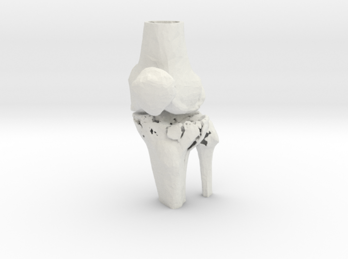 Knee - Proximal Tibia Fracture (Tibial Plateau) 3d printed