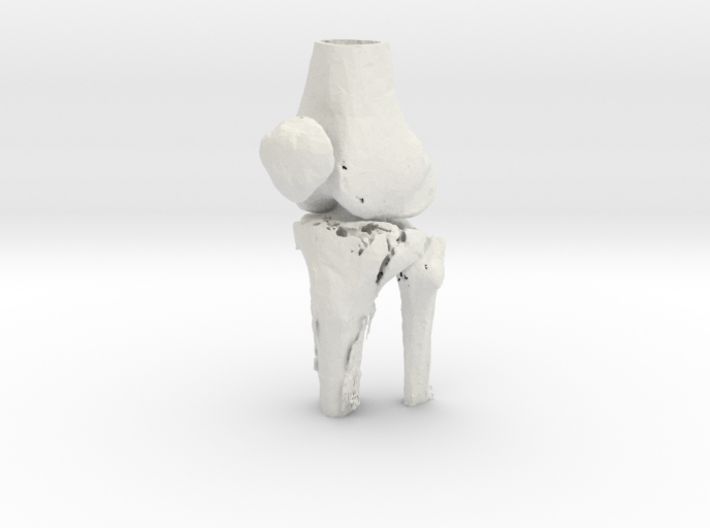 Knee - Proximal Tibia Fracture (Tibial Plateau) 3d printed