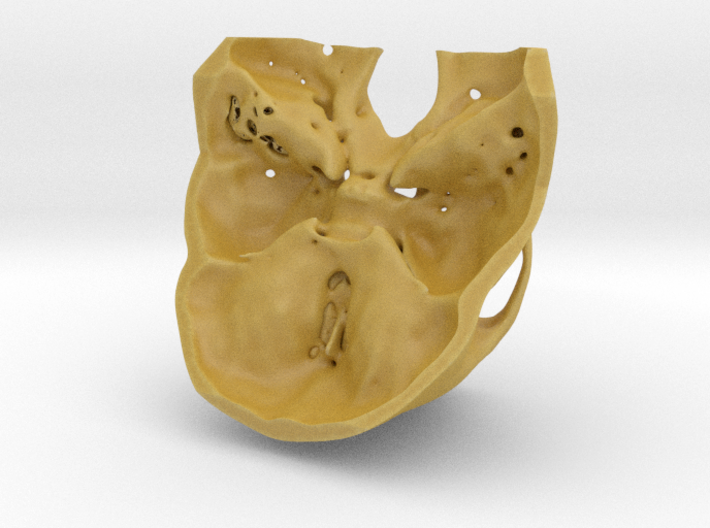 Subject 6a | Facial Skeleton 3d printed 