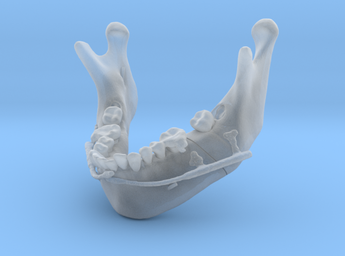 Subject 2i | Mandible + Distractors (After IMDO) 3d printed