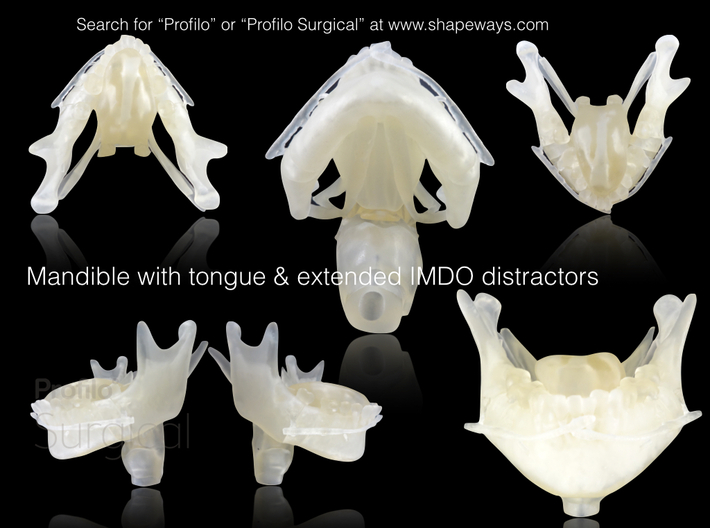 Subject 2l | Mandible + Tongue + Distractors (Afte 3d printed Printed model