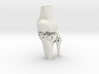 Knee - Proximal Tibia Fracture (Tibial Plateau)   3d printed 